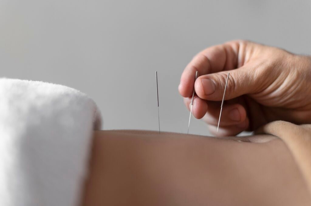 que-es-la-acupuntura